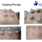 Cupping Therapy by Dr. Abid Ullah Physiotherapist 85x85